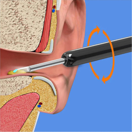 Earwax Removal Kit– Smart Visual Earwax Removal Tool 👂📱